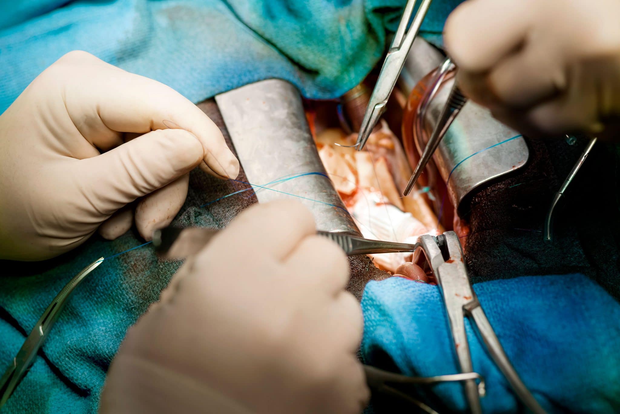 Photographe bloc opératoire. Opération à cœur ouvert dans un hôpital du groupe Ramsay santé